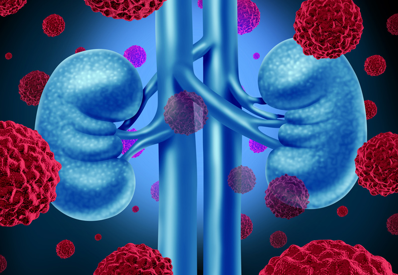 Digital-illustration-of-kidney-cancer