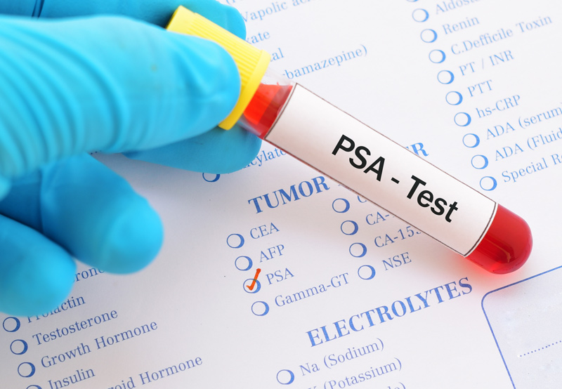 Gloved-hand-holding-blood-sample-for-elevated-PSA-levels-test