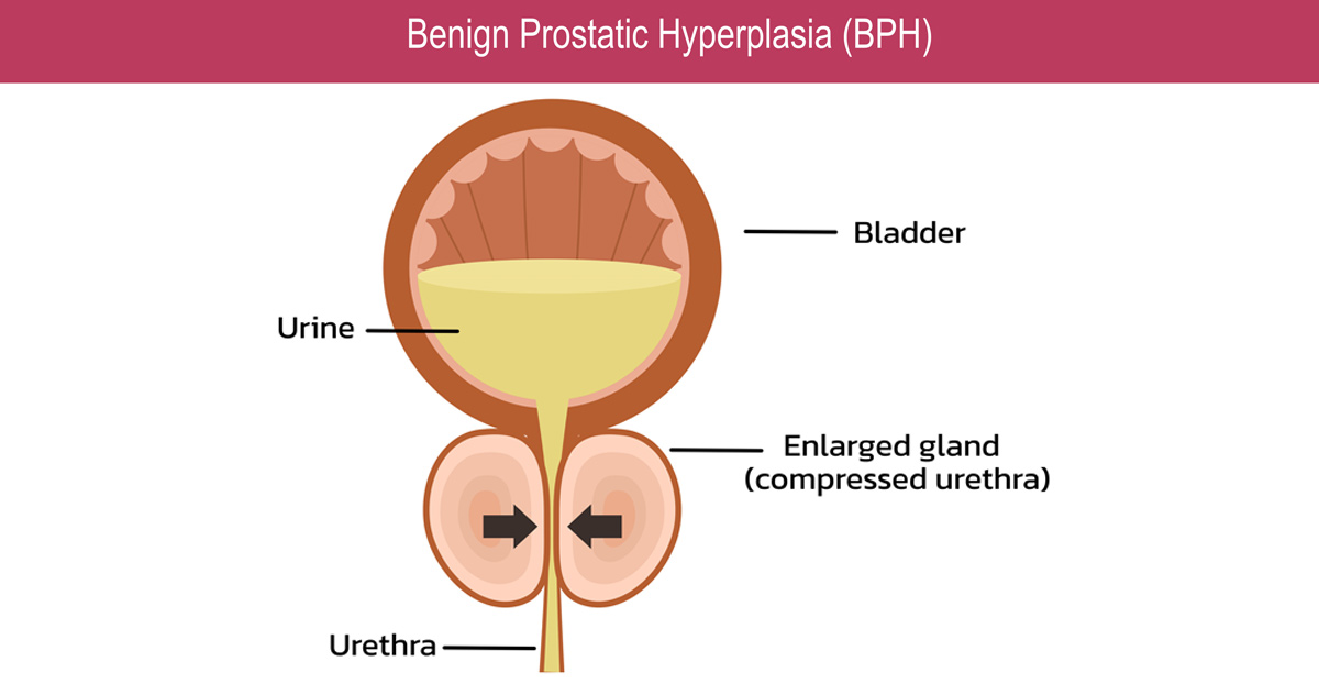 Illustration-of-benign-prostatic-hyperplasia