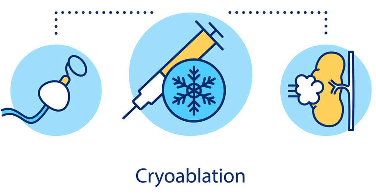 illustrated-concept-of-cryoablation