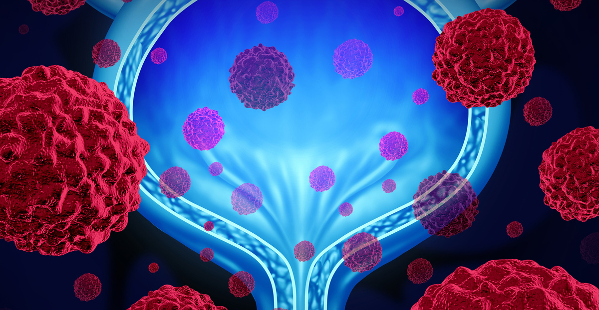 illustration-of-bladder-cancer