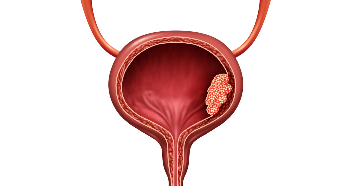 Cystectomy Urologic Oncologist Dr Michael Daneshvar Uci Urology 