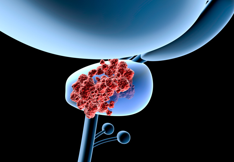 illustration-of-prostate-cancer